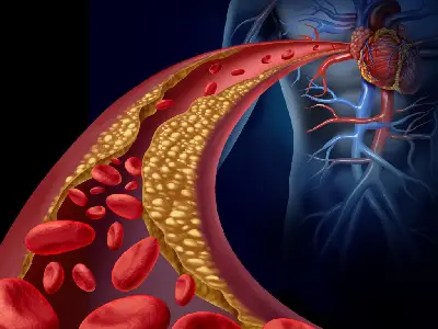 Cholesterol Disorders